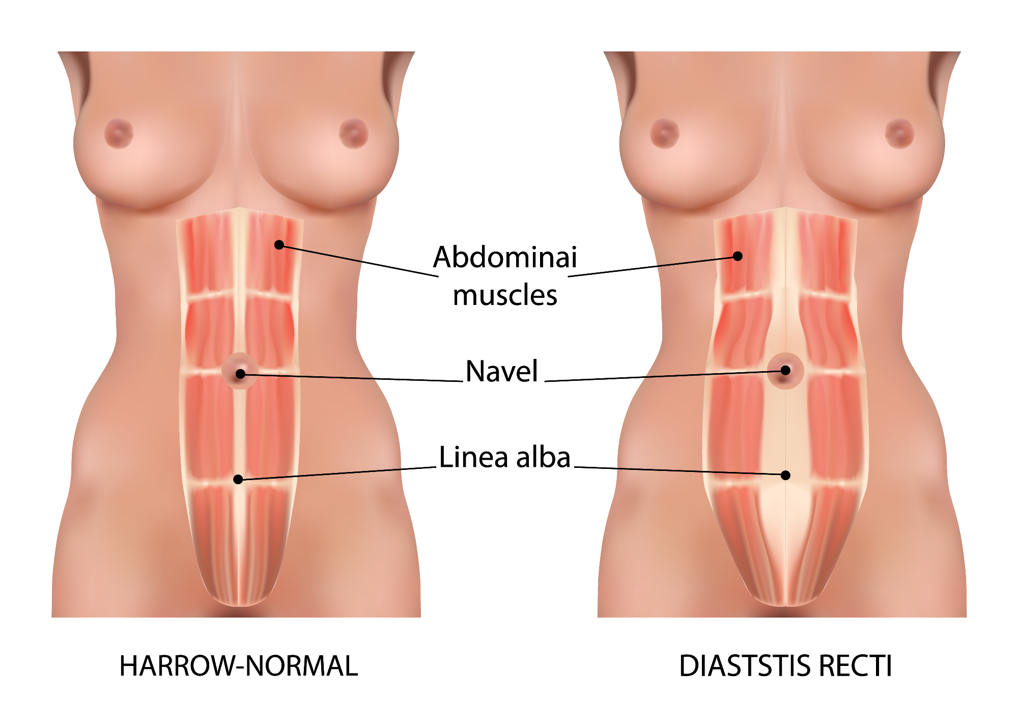 Diastaza me je naučila, da telo po porodu potrebuje čas, razumevanje in nežnost.